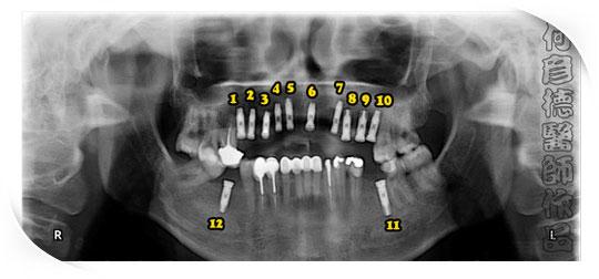 牙种植中引导骨再生膜的研究进展
