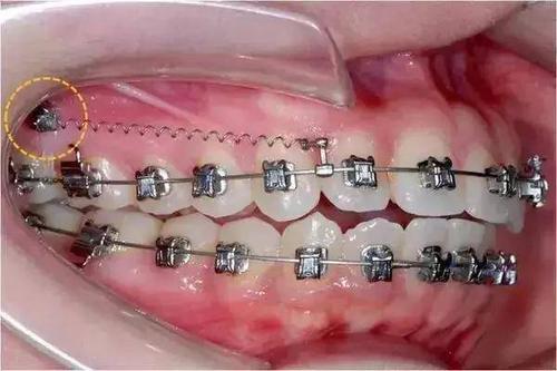 牙齿正畸或需“打个钉”作为辅助工具