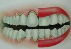 牙龈萎缩有什么表现？造成牙龈萎缩的原因