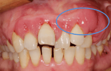 牙龈增生与降压药有什么关系？