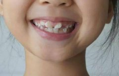 孩子新换的门牙出现锯齿状？这是什么原因？