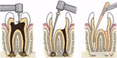 介绍几种较为常见的、适用根管治疗的牙体疾病